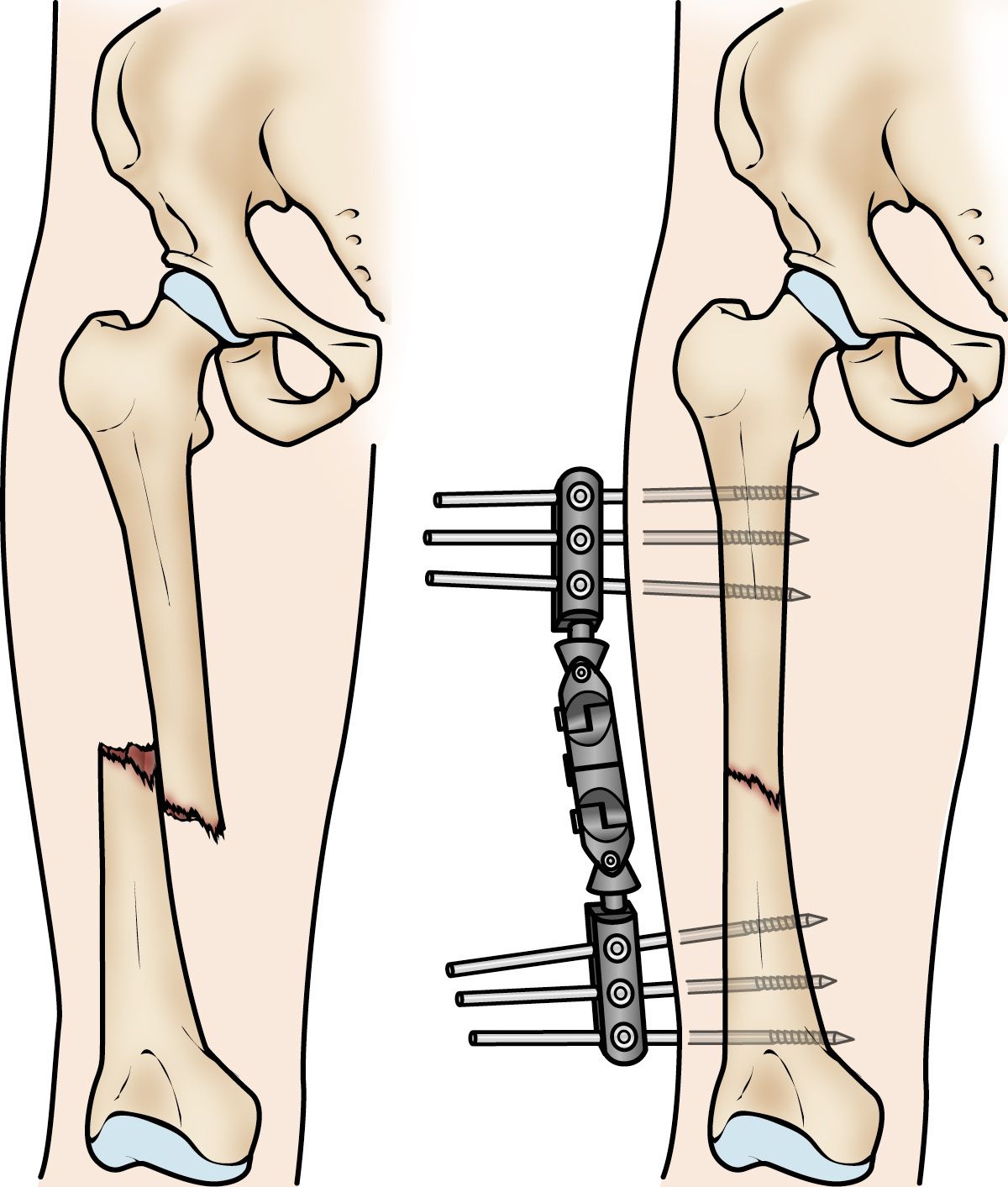 External fixation of a femoral shaft fracture